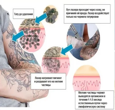 Лазерное удаление татуажа в Москве | Пикосекундный лазер PicoSure
