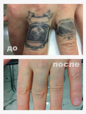 Удаление татуировок лазером в Москве - цены на лазерное удаление татуировок  в клинике Damas Clinic (м. Таганская)