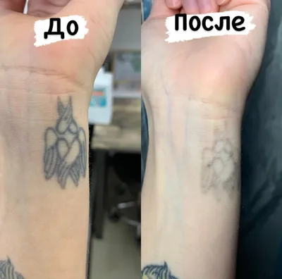 Удаление тату лазером. - удаление цветной татуировки в Москве | L'Art Clinic