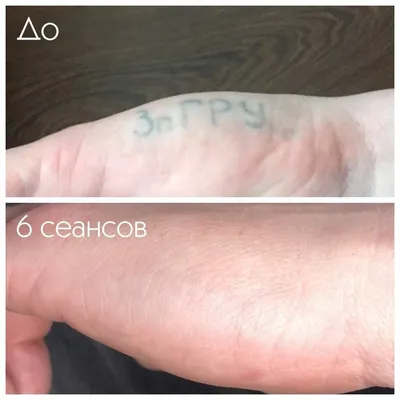 Лазерное удаление татуажа в Москве - цены, запись на прием | Клиника  лазерной косметологии Candela