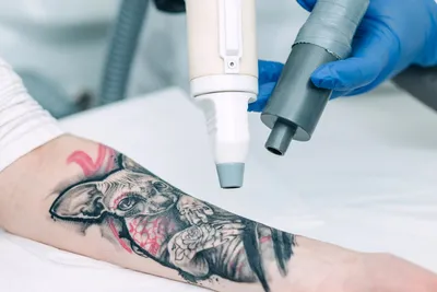 Подробнее о лазерном удалении татуажа и тату (татуировок) - блог LBar
