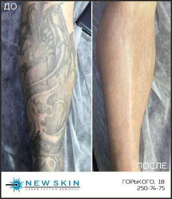 Как удалить татуировку - удаление тату лазером | До и после