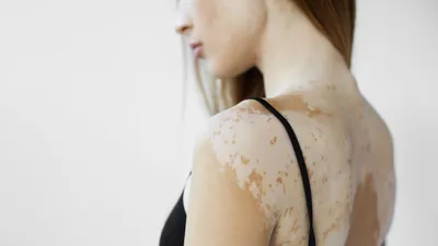 Бляшки на коже - причины появления, при каких заболеваниях возникает,  диагностика и способы лечения