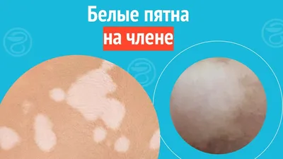 Белые пятна на коже. страница 2