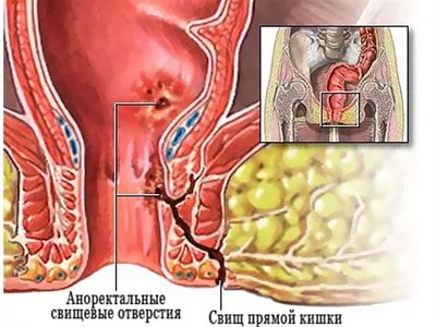 Редкий диагноз: периаурикулярный свищ (Infra-auricular sinus) - история  лечения в Ильинской больнице.