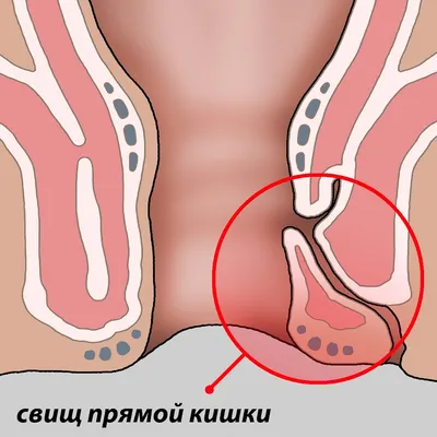 Свищ подбородка и больной зуб | Пикабу