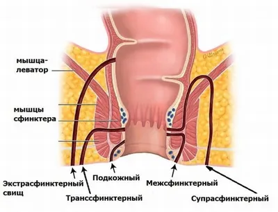 Лечение свищей прямой кишки