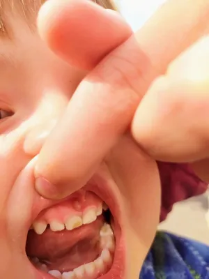Лечение свища на десне у ребенка — цены в детской стоматологической клинике  «Мартинка» в Москве