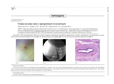 ЛИГАТУРНЫЙ СВИЩ после кесарева... - Medical Centre “AVA\" | Facebook