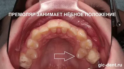 Воспалительные заболевания десен: стоматит, свищ, киста - причины и лечение