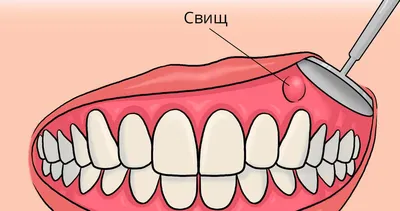 Свищ на десне у ребенка — причины и лечение на Startsmile.ru