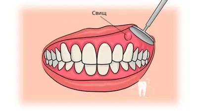 Воспалительные заболевания десен: стоматит, свищ, киста - причины и лечение