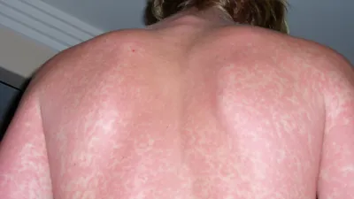 На лице сыпь: причины появления, заболевания и аллергические и угревые  высыпания на коже, лечение