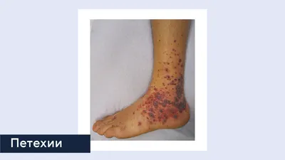 Аллергия на коже: мазь от аллергии на коже, таблетки - аллергия на коже  лечение | Doc.ua