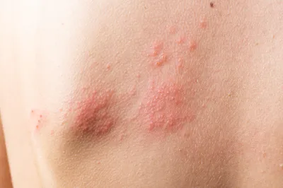 Сыпь на коже может говорить о болезни суставов или волчанке. Что нужно  знать — Секрет фирмы