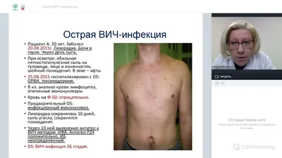 Сыпь при терапии | форум hiv.plus