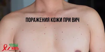 Сыпь при терапии | форум hiv.plus