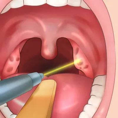 Увулит – симптомы, причины, диагностика и лечение болезни у взрослых |  «Будь Здоров»
