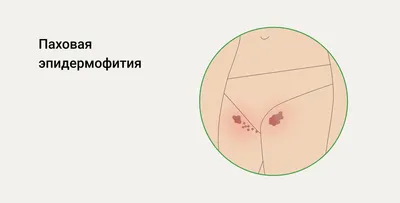 Симптомы кандидозного вульвита и способы его лечения — блог медицинского  центра ОН Клиник