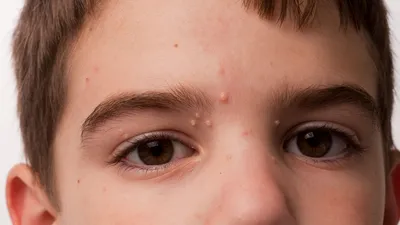 Сыпь глаз кожа стрептодермия - Вопрос дерматологу - 03 Онлайн