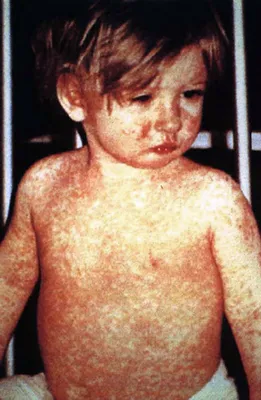 Сыпь при детских инфекциях: краткий обзор для родителей