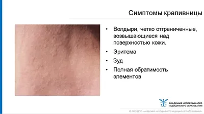 Dr Alp Tunç - Аллергическая крапивница(уртикария)-это сыпь в виде волдырей  розоватого оттенка, которые возвышаются над поверхностью кожи, при  надавливании на них они исчезают. У больного присутствует сильный зудв  месте поражения.Поскольку крапивница —