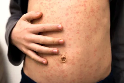 Аллергия или корь? Как понять, что за сыпь на теле у ребёнка? | Детская  медицина Вирилис | Дзен