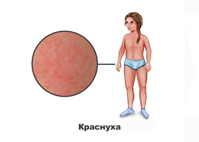 Детские инфекции: краснуха – в чем ее причины, как проявляется и как ее  нужно лечить | О детском здоровье: с врачебного на родительский | Дзен