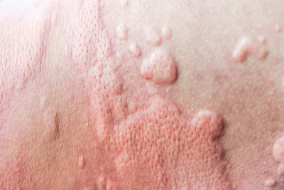 Инфекционная эритема (Erythema infectiosum)