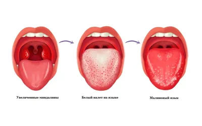Проявления бактериальных инфекций в полости рта