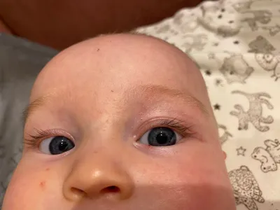 Сыпь вокруг глаз у ребенка фото фото