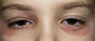 Бесцветная сыпь вокруг глаз - Вопрос дерматологу - 03 Онлайн