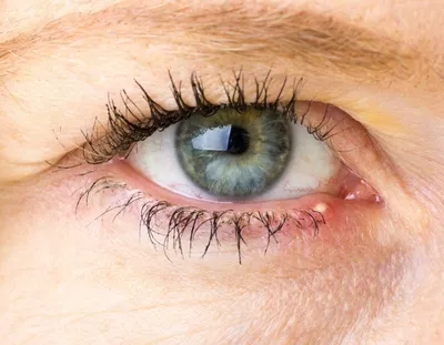 Шелушение под глазами и вокруг глаз - причины и лечение -  Офтальмологические клиники «Эксимер» (Одесса) - диагностика и лечение  заболеваний глаз у взрослых и детей