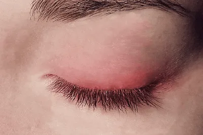Красные точки вокруг глаз у ребенка — возможные причины появления сыпи -  YouTube