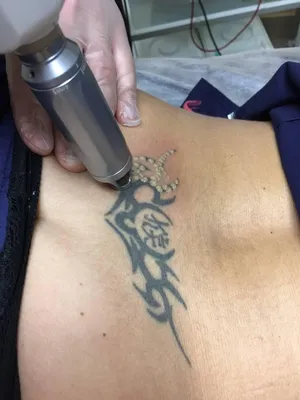 Лазерное удаление татуажа и татуировок в Киеве - удалить тату по цене в  Goldlaser