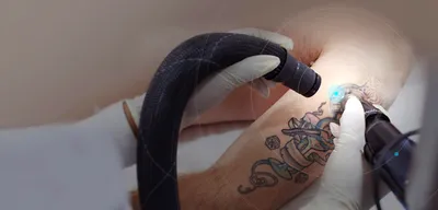 Удаление татуировок лазером, лазерное удаление татуировок