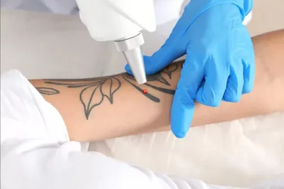 Удалить тату ♻️ Лазерное удаление татуировок и татуажа в Киеве | Мед Сити