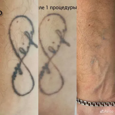 Перекрытие старых татуировок в Пензе - Татуировки - Красота: 15 тату-мастеров  со средним рейтингом 4.8 с отзывами и ценами на Яндекс Услугах
