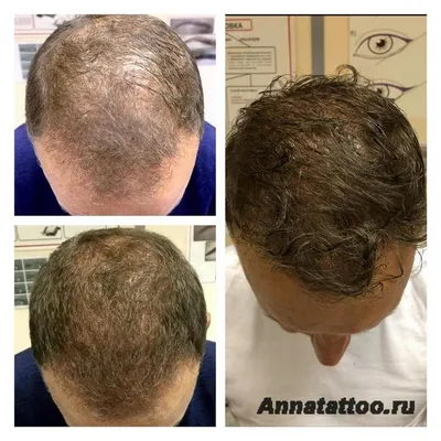 Трихопигментация волос Новосибирск! Татуаж волос или Медицинский татуаж  головы