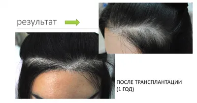 Трихопигментация волос в Москве: цена на татуаж волос на голове в студии от  20 000 руб