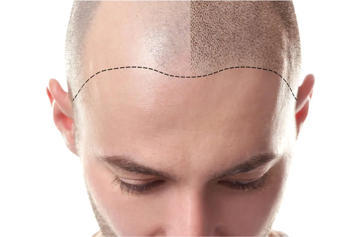 Татуаж лысины на голове у мужчин. Трихопигментация головы. Искусственная лысина. Processing within