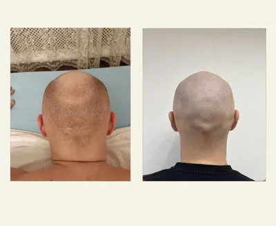 Трихопигментация волос головы мужчин и женщин в Москве — Цены на татуаж с  имитацией волос, отзывы, фото
