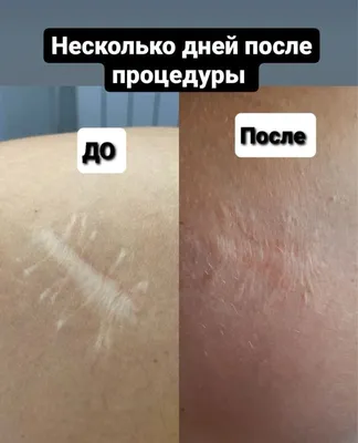 Лазерное удаление шрамов на лице в Киеве, шлифовка Coolaser Clinic