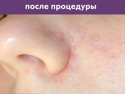 Лазерная коррекция рубцов и шрамов - клиника лазерной косметологии в Москве