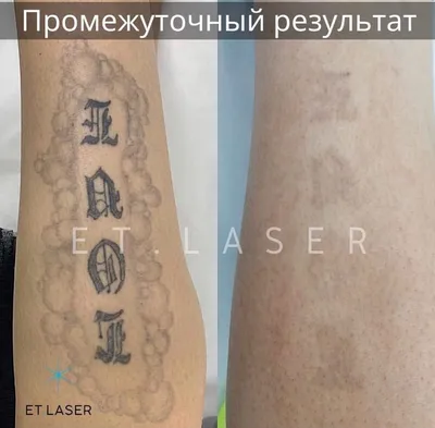 Лазерное удаление шрамов на лице в Киеве, шлифовка Coolaser Clinic