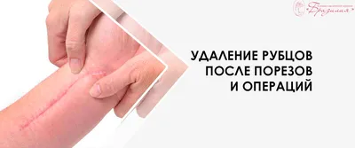 Удаление шрамов: сколько стоит удалить рубцы - цены в СМ-Клиника СПб