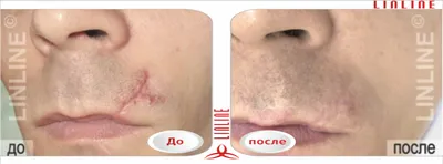 Фотографии до и после удаления рубцов, проводим в клинике Premium Aesthetics