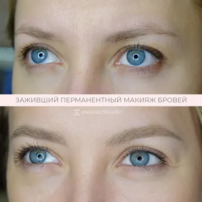 Медицинский камуфляж синяков под глазами | Василиса Климова