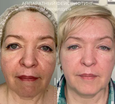 Татуаж глаз, век фото до и после, примеры работ перманентного макияжа в  студии Натальи Еселевич в Новосибирске, Новосибирске