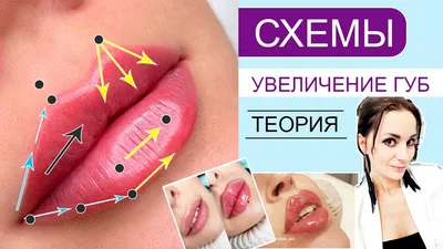 Увеличение губ: техники процедуры, последствия и фото результата | Клиника  ГАЛАКТИКА | Дзен